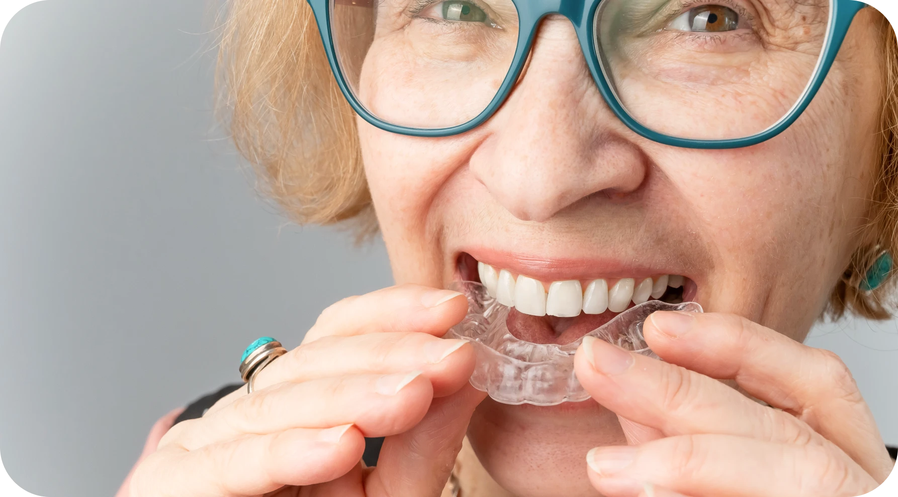 Aligneurs transparents