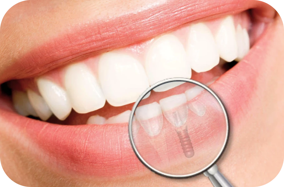 Implant et parodontie : quel lien ?